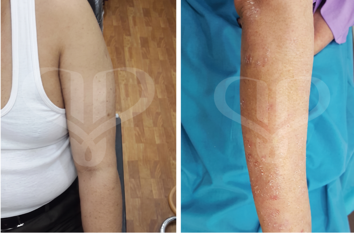 Kondisi perubahan pasien psoriasis vulgaris